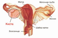 Киста / Онкология - изучение и лечение опухолей, кист, рака